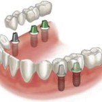 Dental implants