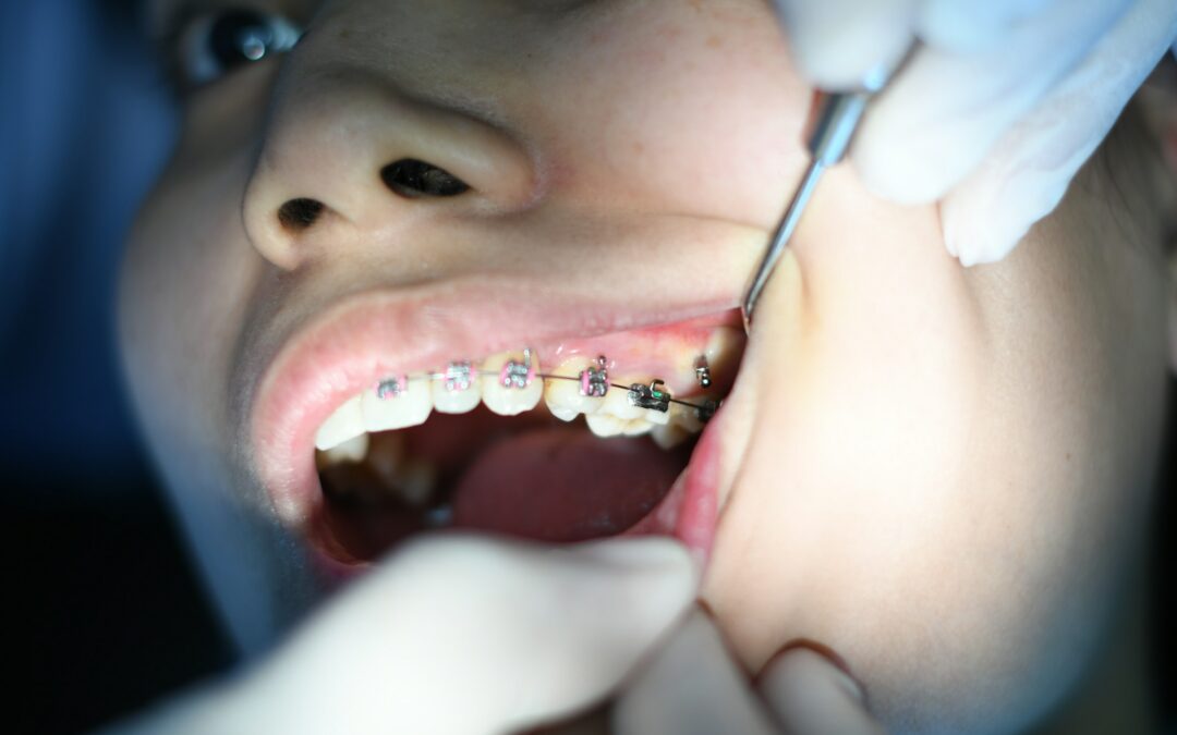 Smiling patient with braces after a first orthodontic appointment in Maricopa